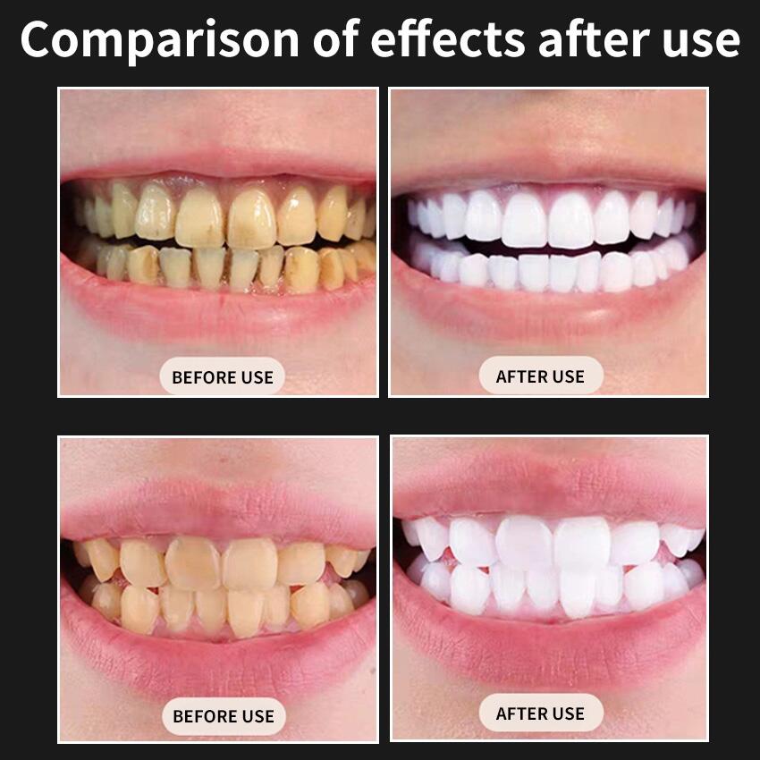 Kit de Branqueamento Dentário Recargável com LED – Sorriso Brilhante em Casa ✨🦷